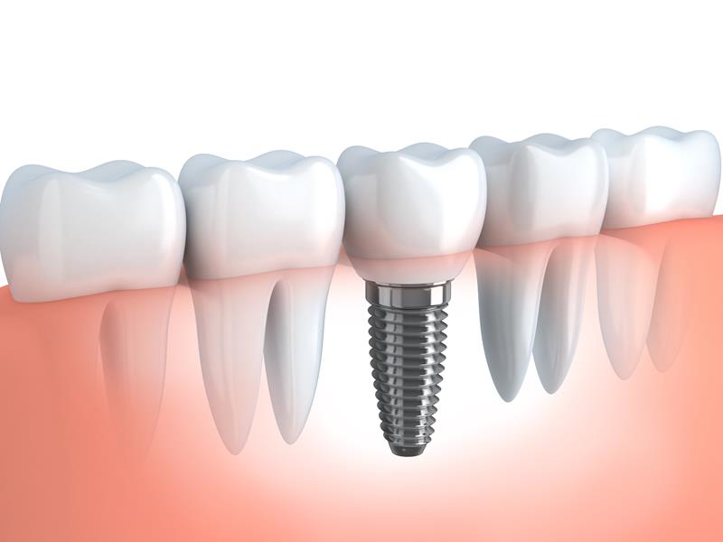 Dental Implants  Philadelphia, PA 